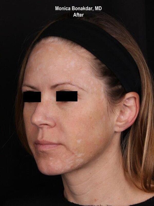 Intense Pulse Light - IPL Before & After Photo