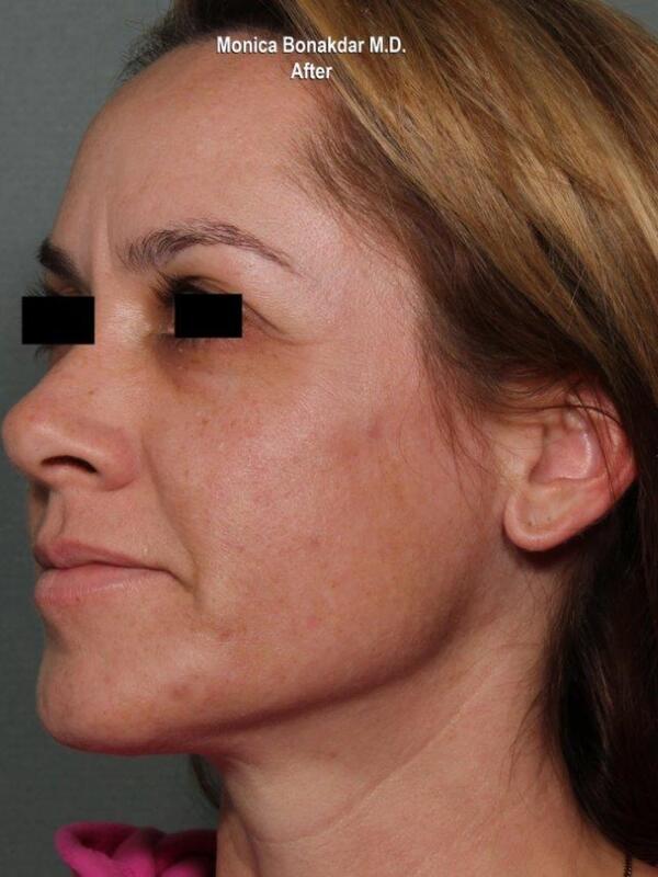 Intense Pulse Light - IPL Before & After Photo