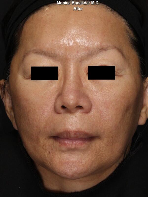 Microneedling Before & After Photo