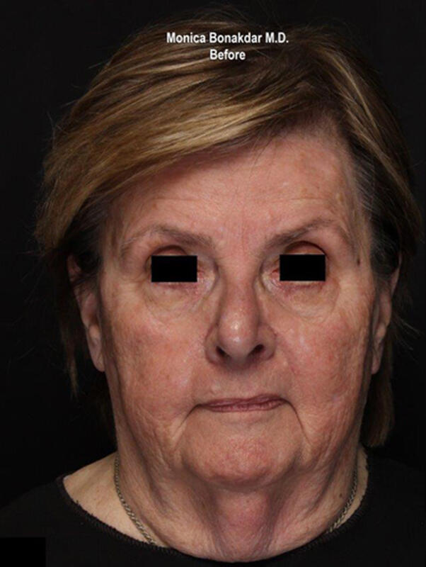 Vascular Laser Before & After Photo