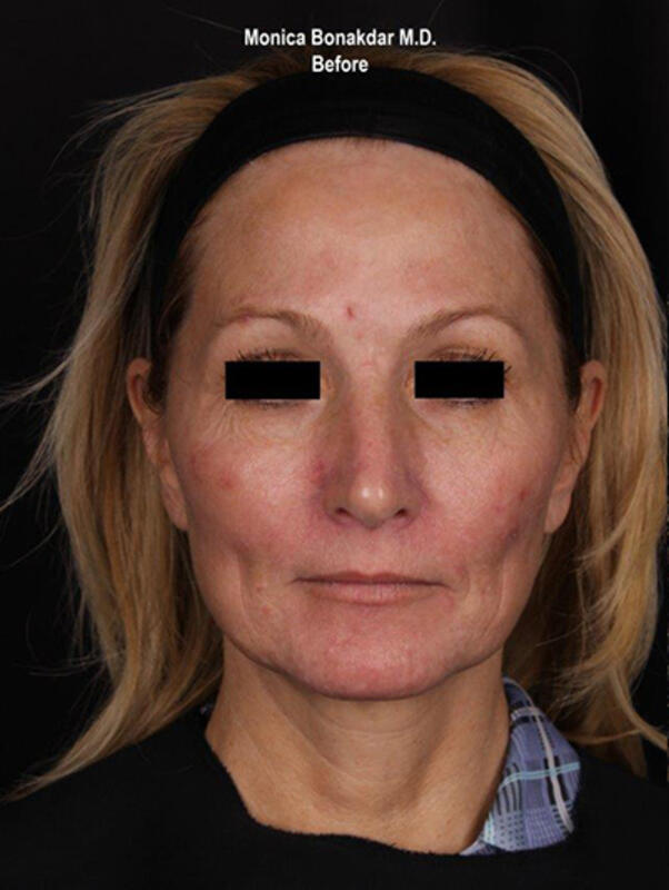 Vascular Laser Before & After Photo