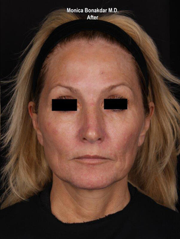 Vascular Laser Before & After Photo