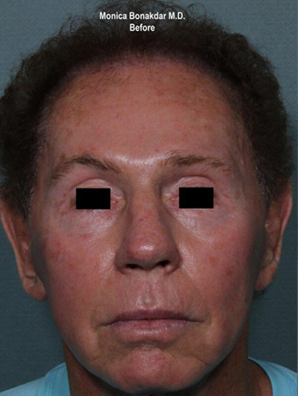 Vascular Laser Before & After Photo