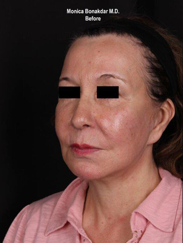 Ultherapy Before & After Photo