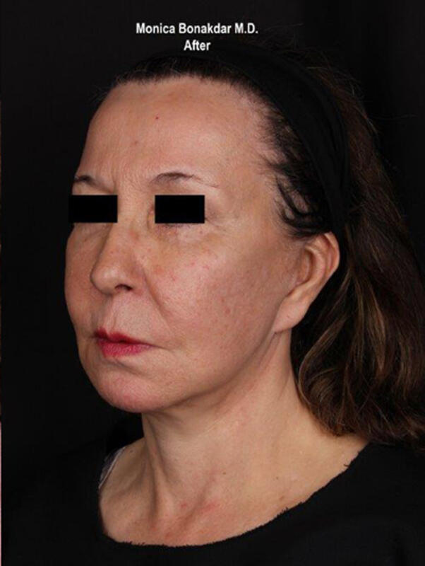 Ultherapy Before & After Photo
