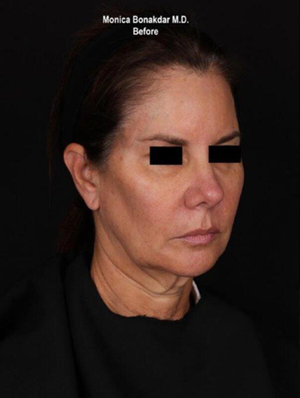 Ultherapy Before & After Photo