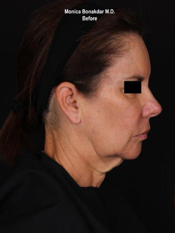 Ultherapy Before & After Photo