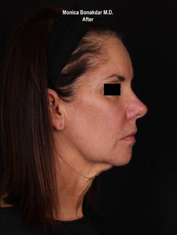 Ultherapy Before & After Photo