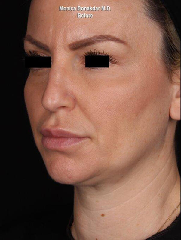 Ultherapy Before & After Photo