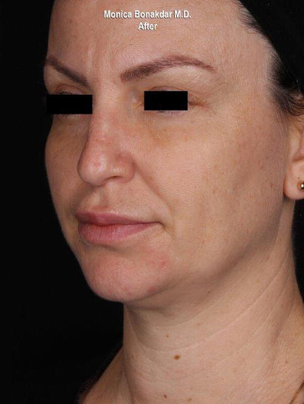 Ultherapy Before & After Photo