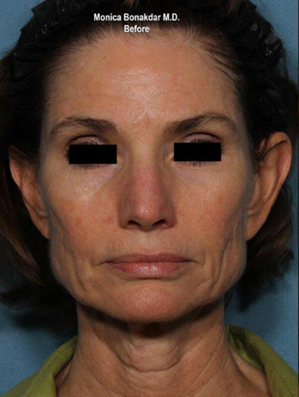 Ultherapy Before & After Photo