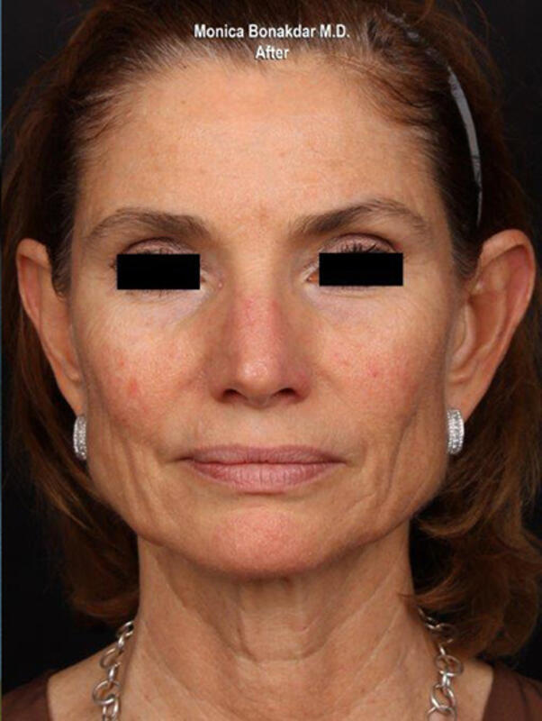 Ultherapy Before & After Photo