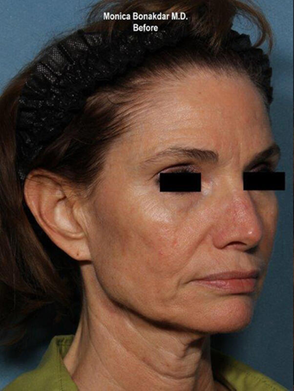 Ultherapy Before & After Photo