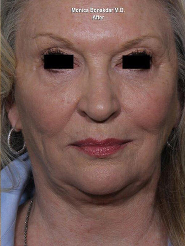 Ultherapy Before & After Photo