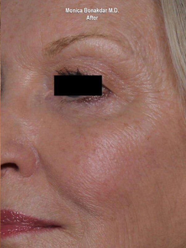 Ultherapy Before & After Photo