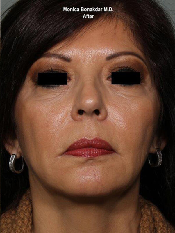 Ultherapy Before & After Photo