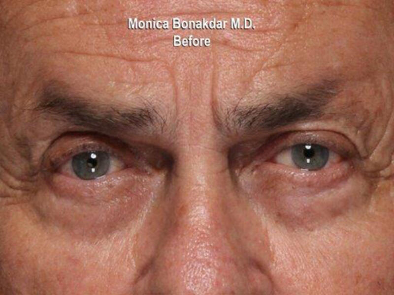 Virtue RF Microneedling Before & After Photo